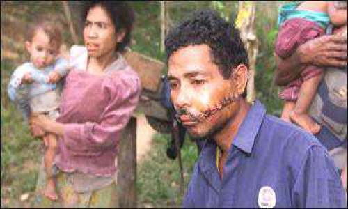 Machete Victim, East Timor, 1999 (BBC Online photo)